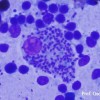 Macrofago gigante ingolfato di Leishmania i. in striscio da agoinfissione da linfonodo
