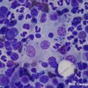 Few macrophages with Leishmania i. in a bone marrow aspirate smear