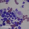 Macrophage contenant la Leishmaniose. L’échantillon a été prélevé à l’aide d’une cytoponction dans la moelle épinière