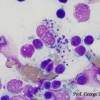 Engulfed macrophage by melanin and Leishmania i. in a lymphnode smear prepared by needle-infixion