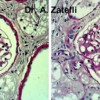 Histological features of mesangial glomerulonephritis in canine leishmaniasis